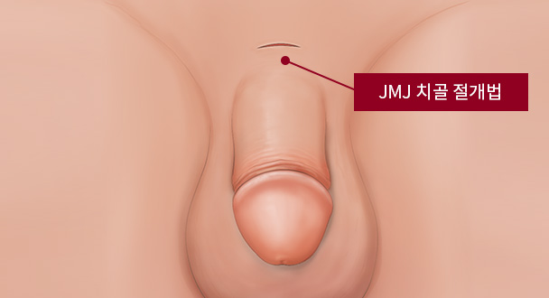 JMJ 치골 절개법 이미지